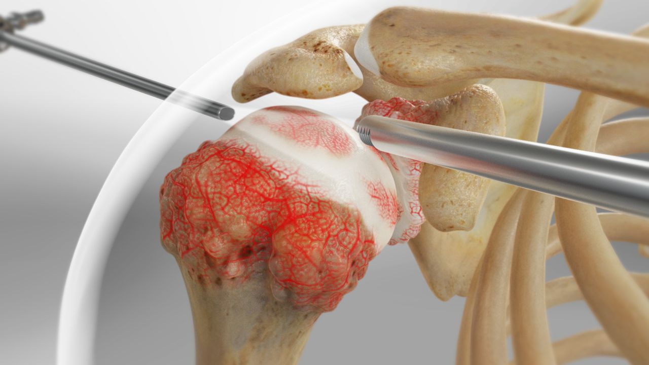 ACL Reconstruction surgery
